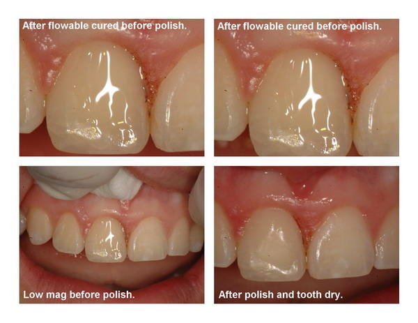 Gingivectomy and restoration Page8_resize.jpg